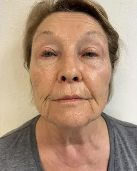 Age 72 — Full Face, Neck and Eye Rejuvenation, Butterfly Facelift® client at Newport Beach Skin Tightening — after photo