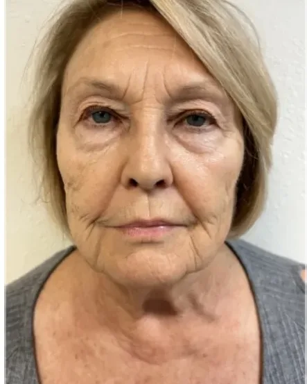 Age 72 — Full Face, Neck and Eye Rejuvenation, Butterfly Facelift® client at Newport Beach Skin Tightening — before photo