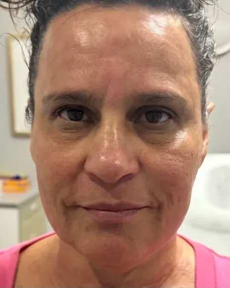 Age 52 — Full-Face Transformation, Butterfly Facelift® client at Newport Beach Skin Tightening — after photo