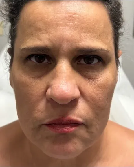 Age 52 — Full-Face Transformation, Butterfly Facelift® client at Newport Beach Skin Tightening — before photo