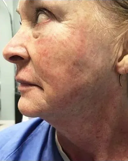 Age 68 — Neck Rejuvenation, Butterfly Facelift® client at Newport Beach Skin Tightening — after photo