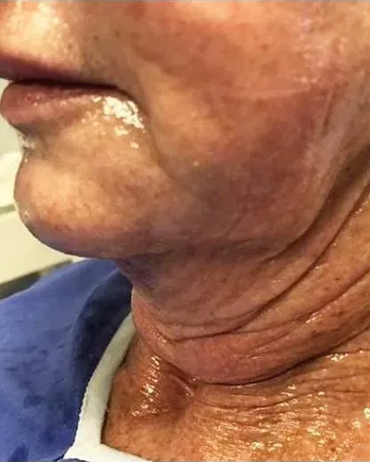 Age 68 — Neck Rejuvenation, Butterfly Facelift® client at Newport Beach Skin Tightening — before photo